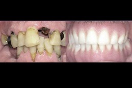 Best Zygomatic Implants Clinic in Dubai