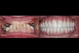 Best Zygomatic Implants in Dubai