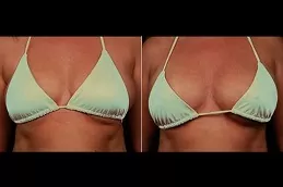 Breast Fillers Injections Clinic in Abu Dhabi