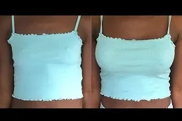 Breast Fillers Injections Clinic in Dubai
