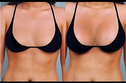 Breast Fillers Injections in Dubai