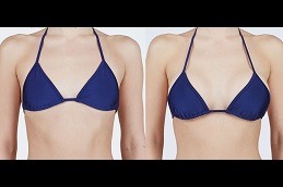 Breast Surgery Clinic in Dubai