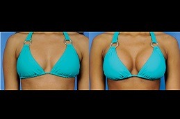 Breast Surgery in Dubai