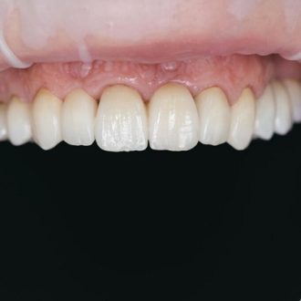 Can Veneers Break Easily in Dubai & Abu Dhabi?