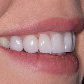 Can You Go Back To Normal Teeth After Veneers?