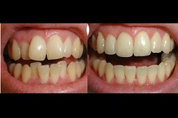 Clear Aligners Clinic in Dubai
