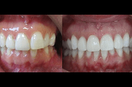 Clear Aligners in Dubai