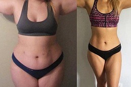 Does Gastric Plication Work For Weight Loss Clinic in Dubai & Abu Dhabi