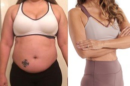 Does Gastric Plication Work For Weight Loss in Dubai