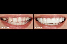 Does Hollywood Smile Last Forever Clinic in Abu Dhabi