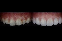 Does Hollywood Smile Last Forever Clinic in Dubai & Abu Dhabi