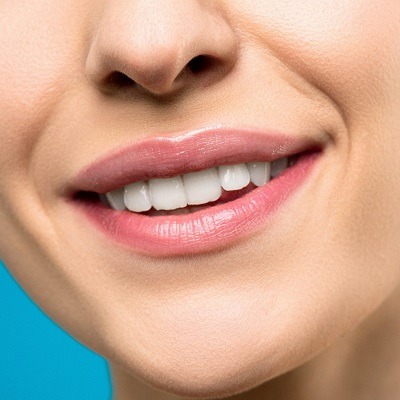 Does Hollywood Smile Last Forever in Dubai, Abu Dhabi & Sharjah Cost