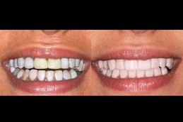 Does Hollywood Smile Last Forever in Dubai