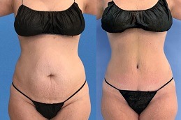 Does Liposuction Treatment Leaves A Scar Clinic in Abu Dhabi