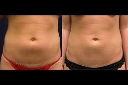 Does Liposuction Treatment Leaves A Scar Clinic in Dubai & Abu Dhabi