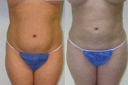 Does Liposuction Treatment Leaves A Scar in Dubai