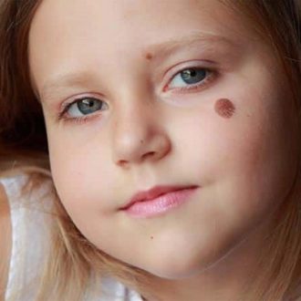 Erasing The Mark: Treatment Methods For Birthmark Removal