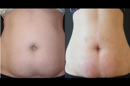 Eximia Treatment Non Surgical Fat Reduction Clinic in Abu Dhabi