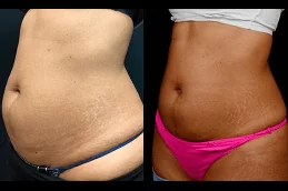 Eximia Treatment Non Surgical Fat Reduction Clinic in Dubai & Abu Dhabi