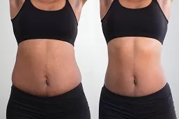 Eximia Treatment Non Surgical Fat Reduction in Dubai