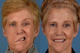 Facial Pain in Dubai