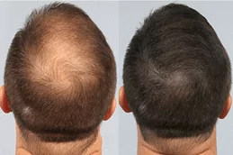 G Cell Treatment in Dubai