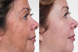 Glutathione Pills For Skin Whitening Clinic in Abu Dhabi