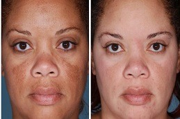 Glutathione Pills For Skin Whitening Clinic in Dubai & Abu Dhabi