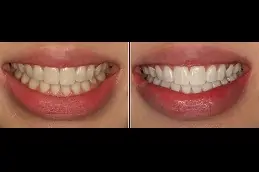 Home Teeth Whitening Clinic in Abu Dhabi