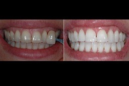 Home Teeth Whitening Clinic in Dubai & Abu Dhabi