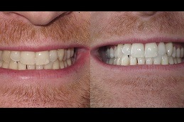 Home Teeth Whitening in Dubai