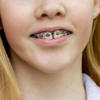 How Do I Care For My Teeth After Braces?