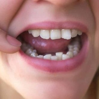 How Long Do Braces Take To Straighten Crowded Teeth?