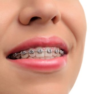 How Long Do Metal Braces Stay On in Dubai?