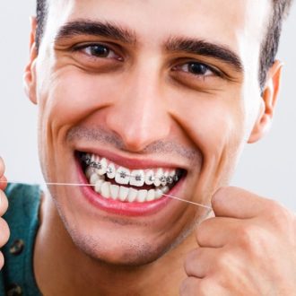 How Long Do You Wear Braces in Dubai?