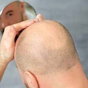 How Long Until The Swelling Goes Down After A Hair Transplant?
