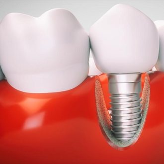 How Many Teeth Can Dental Implants Replace?