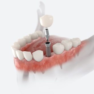 How Many Teeth Do You Need For The Implants?