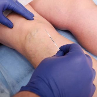 How To Prepare For Vascular Surgery in Dubai