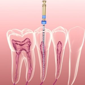 Is Extraction Of A Tooth a Better Alternative To Root Canal Treatment?