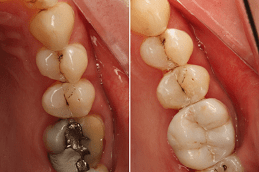 Is Extraction Of A Tooth a Better Alternative To Root Canal Treatment Clinic in Abu Dhabi