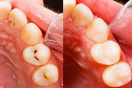 Is Extraction Of A Tooth a Better Alternative To Root Canal Treatment Clinic in Dubai & Abu Dhabi