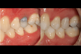 Is Extraction Of A Tooth a Better Alternative To Root Canal Treatment in Dubai