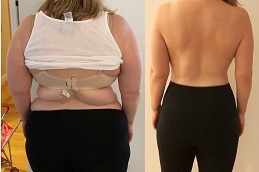 Is Gastric Bypass A Permanent Weight Loss Procedure Clinic in Abu Dhabi