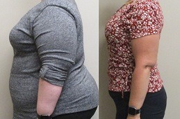 Is Gastric Bypass A Permanent Weight Loss Procedure Clinic in Dubai & Abu Dhabi