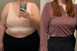 Is Gastric Bypass A Permanent Weight Loss Procedure in Dubai