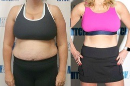 Is Weight Loss With The Mini Gastric Bypass Safe Clinic in Abu Dhabi