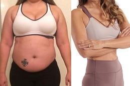 Is Weight Loss With The Mini Gastric Bypass Safe in Dubai