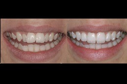Sports Clear Aligners Clinic in Abu Dhabi