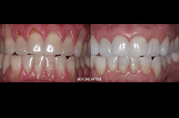 Surgical Tooth Removal Clinic in Abu Dhabi